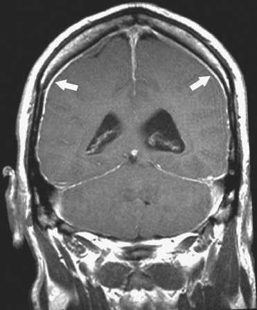 Magnetic resonance image showing diffuse meningeal enhancement after gadolinium administration...