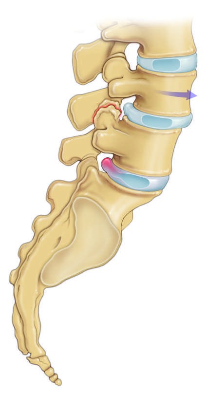 In this T2-weighted axial lumbar MRI, bilateral neuroforaminal narrowing secondary...