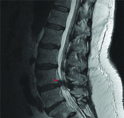In this T2-weighted axial lumbar MRI, bilateral neuroforaminal narrowing secondary...