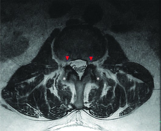 In this T2-weighted axial lumbar MRI, bilateral neuroforaminal narrowing secondary...