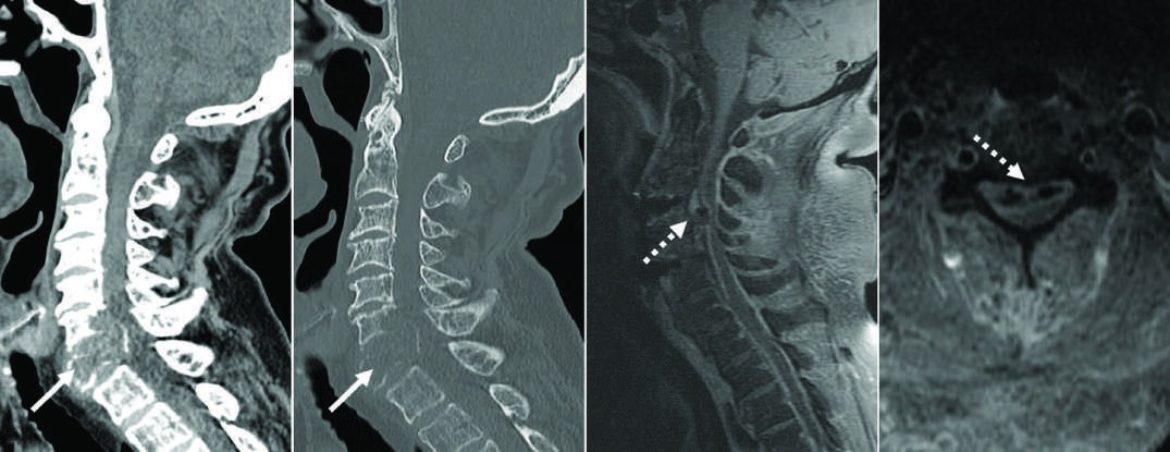 Cases of degenerative cervical disk disease and degenerative cervical (arrowhead)...
