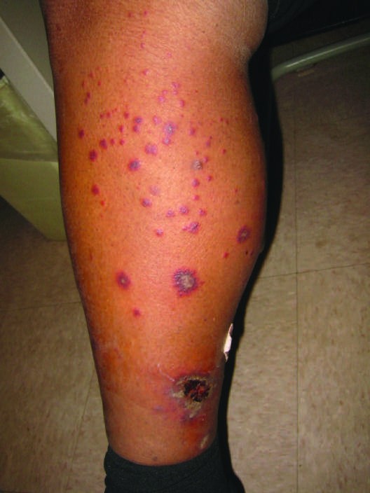morphologies, including petechial