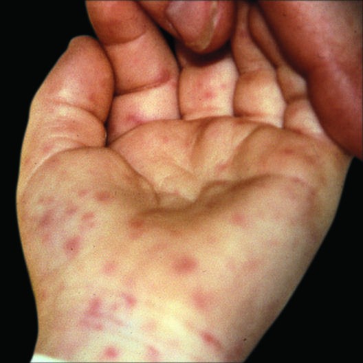 Peripheral eruption on the wrist and palm exhibiting erythematous macules...