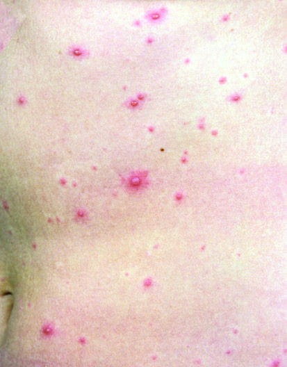 and Rash FIGURE 21-3 Confluent desquamation in a patient with...