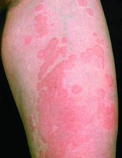 and Rash FIGURE 21-3 Confluent desquamation in a patient with...