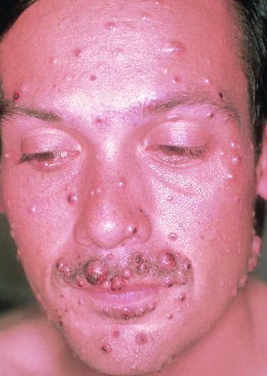 morphologies, including petechial