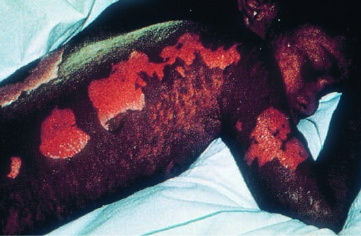 and Rash FIGURE 21-3 Confluent desquamation in a patient with...