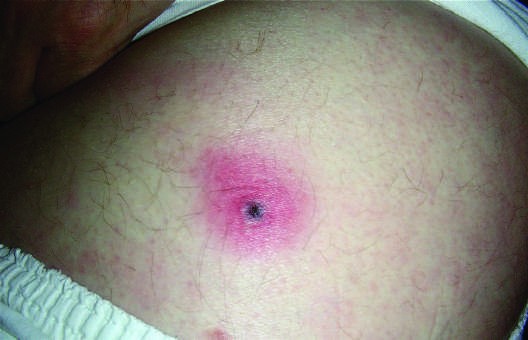 morphologies, including petechial