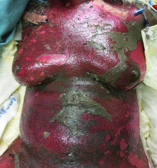 Drug Reactions FIGURE 63-14 Atypical target-like lesion in SJS