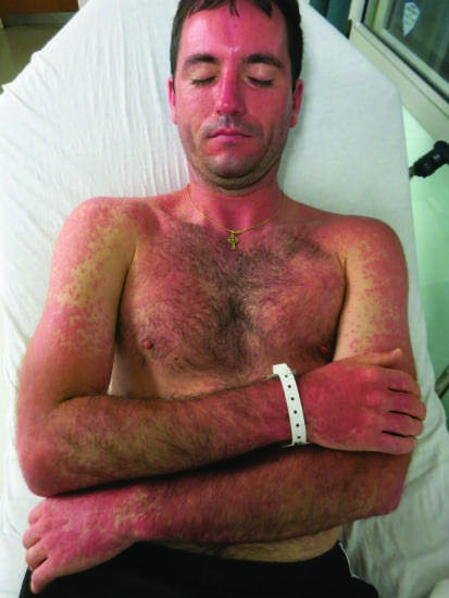 Drug Reactions FIGURE 63-6 Allergic contact dermatitis (bullous) due to...