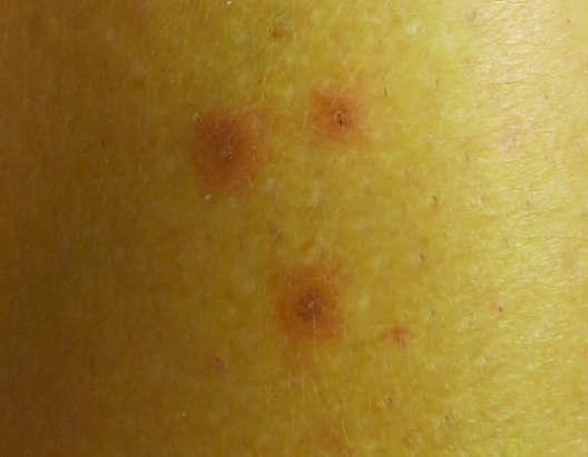 Drug Reactions FIGURE 63-14 Atypical target-like lesion in SJS