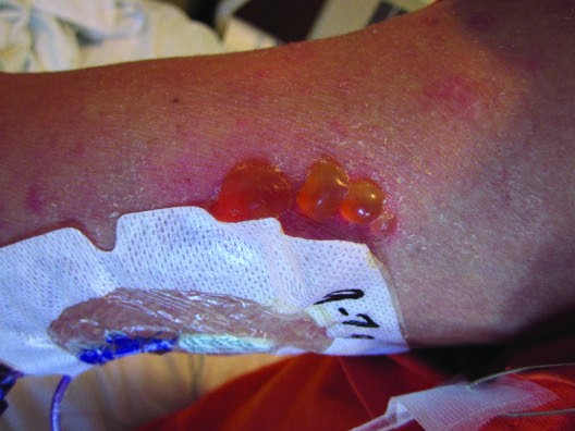 Drug Reactions FIGURE 63-6 Allergic contact dermatitis (bullous) due to...