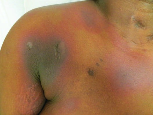 Drug Reactions FIGURE 63-6 Allergic contact dermatitis (bullous) due to...