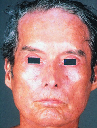 Development of an expressionless, masklike facies in a patient with...