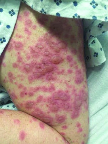 Drug Reactions FIGURE 63-14 Atypical target-like lesion in SJS