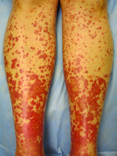 Cutaneous small-vessel vasculitis (CSVV, leukocytoclastic vasculitis)