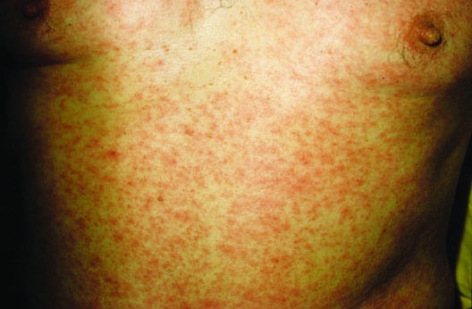 Morbilliform drug eruption