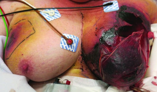 Cutaneous Drug Reactions FIGURE 63-3 Warfarin necrosis involving the breasts