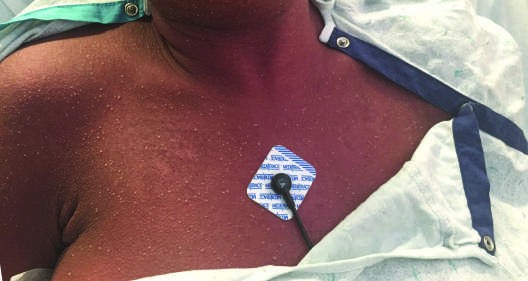 Drug Reactions FIGURE 63-14 Atypical target-like lesion in SJS