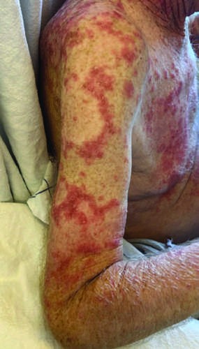 Subcutaneous lupus erythematosus due to medication