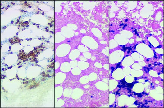Laboratory features of AL amyloidosis