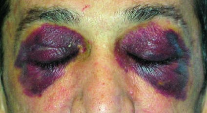 Clinical signs of AL amyloidosis