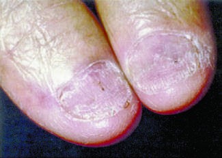 Clinical signs of AL amyloidosis