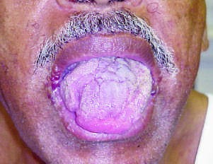 Clinical signs of AL amyloidosis