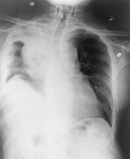 Superior vena cava syndrome (SVCS)
