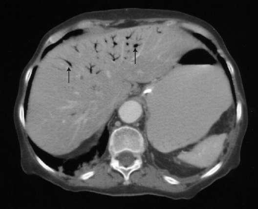 Abdominal computed tomography (CT) scans of a 72-year-old woman with...