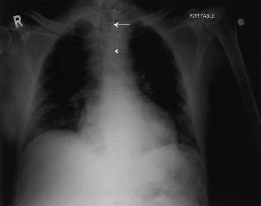 Airway obstruction