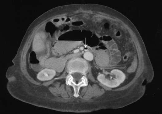 Abdominal computed tomography (CT) scans of a 72-year-old woman with...