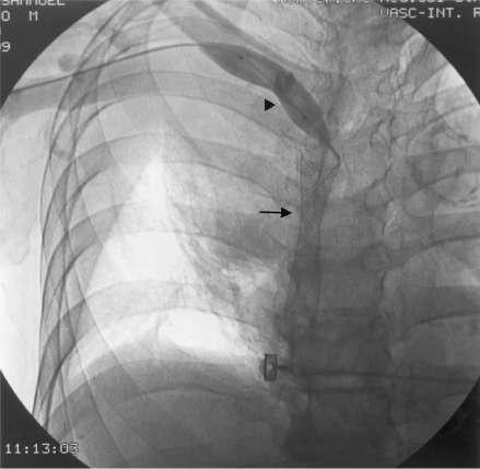 Superior vena cava syndrome (SVCS)