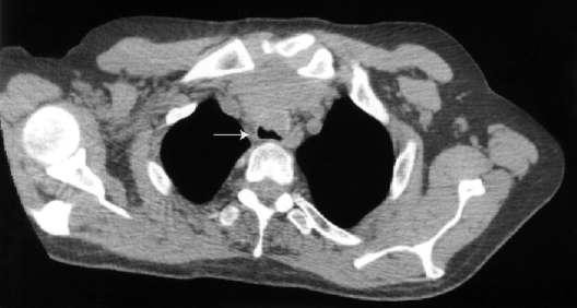 Airway obstruction