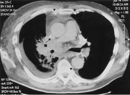 Superior vena cava syndrome (SVCS)