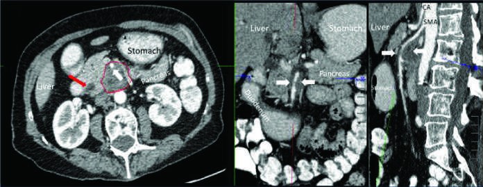 Pancreatic Cancer FIGURE 88-2 Selected images from contrast-enhanced computed tomography...