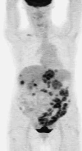 Pancreatic Cancer FIGURE 88-2 Selected images from contrast-enhanced computed tomography...