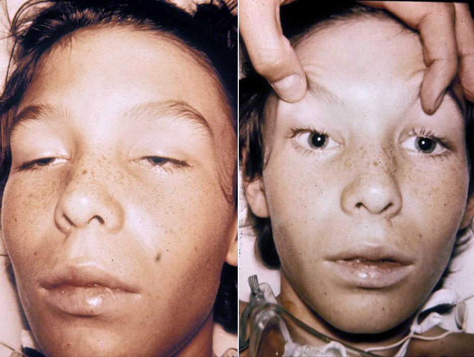 Clinical manifestations of botulism: The image likely depicts the characteristic...
