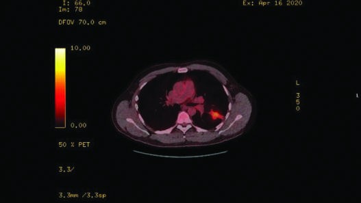 A FIGURE 175–5 Dense consolidation in the left lung of...