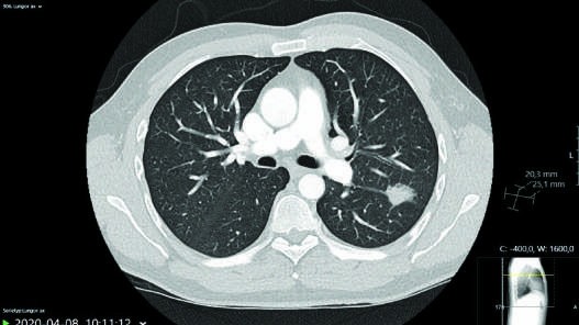 A FIGURE 175–5 Dense consolidation in the left lung of...