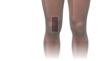 Patient presenting with ulceroglandular tularemia 3 weeks after onset of...