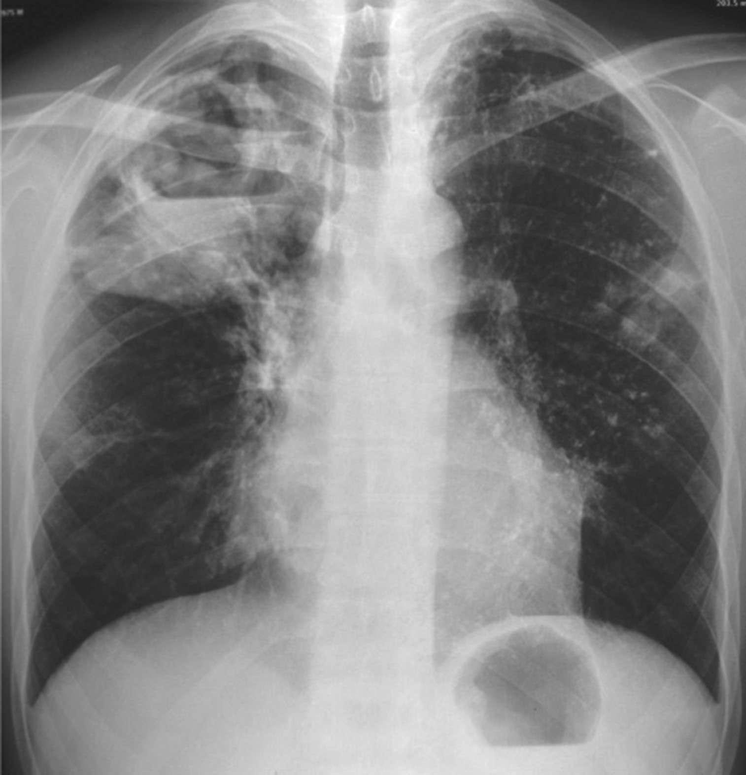 Chest radiograph showing right hilar lymph node enlargement with infiltration...