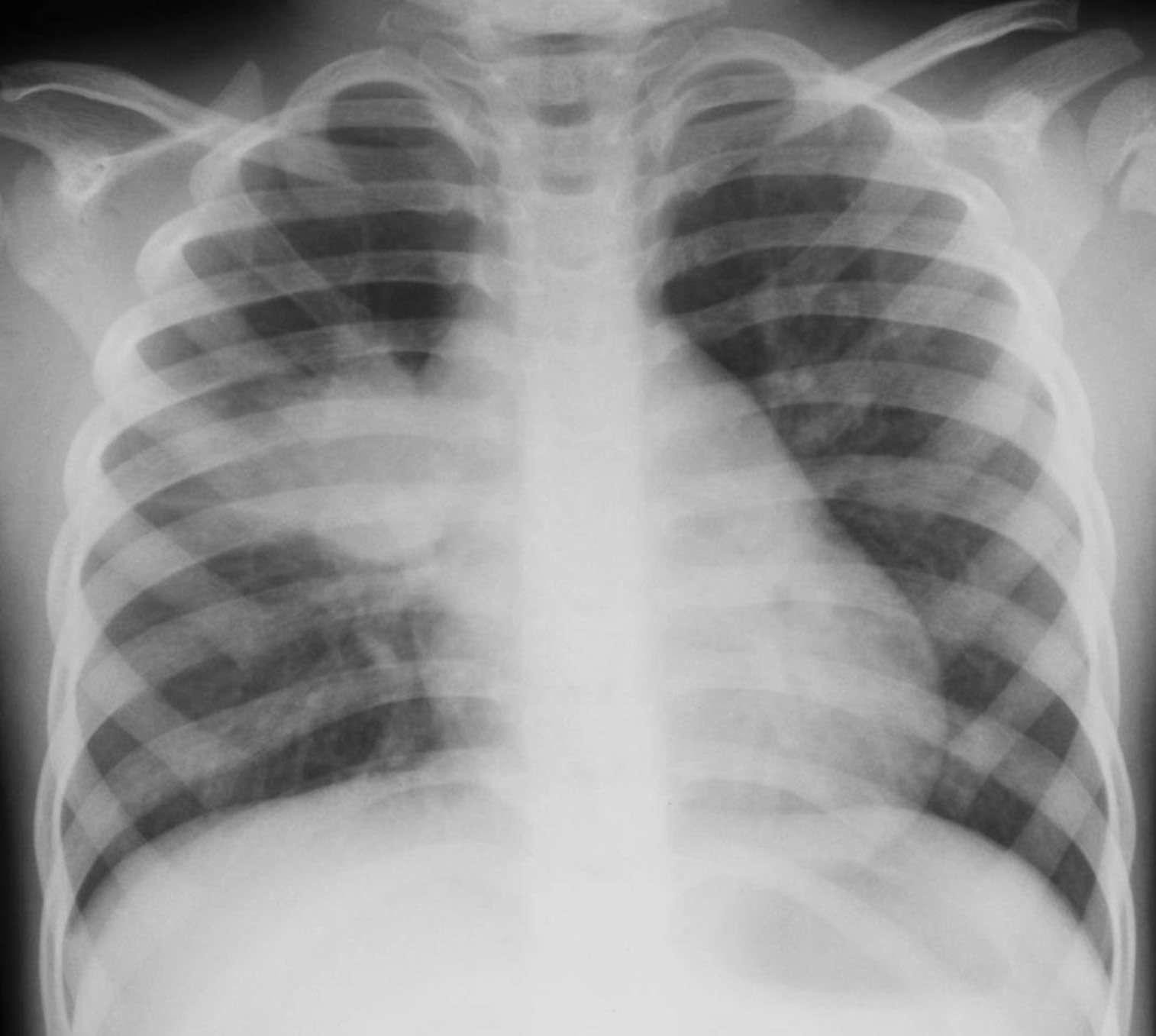 Chest radiograph showing right hilar lymph node enlargement with infiltration...
