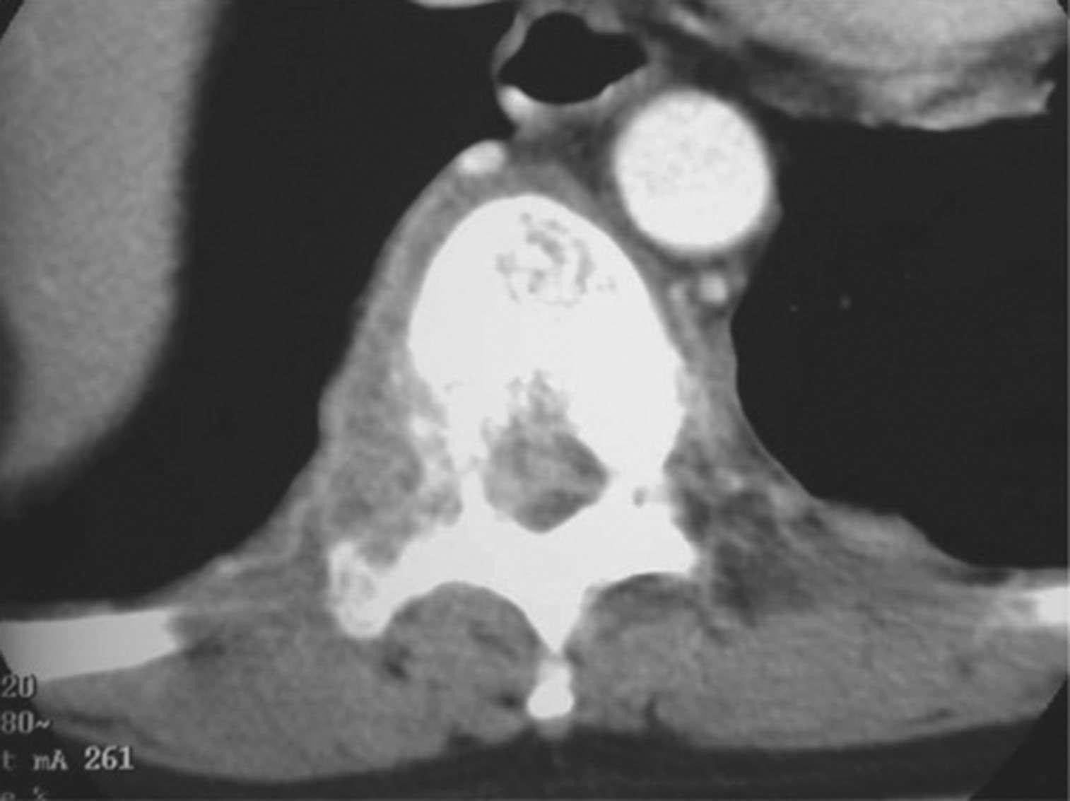 may involve any portion of the genitourinary tract