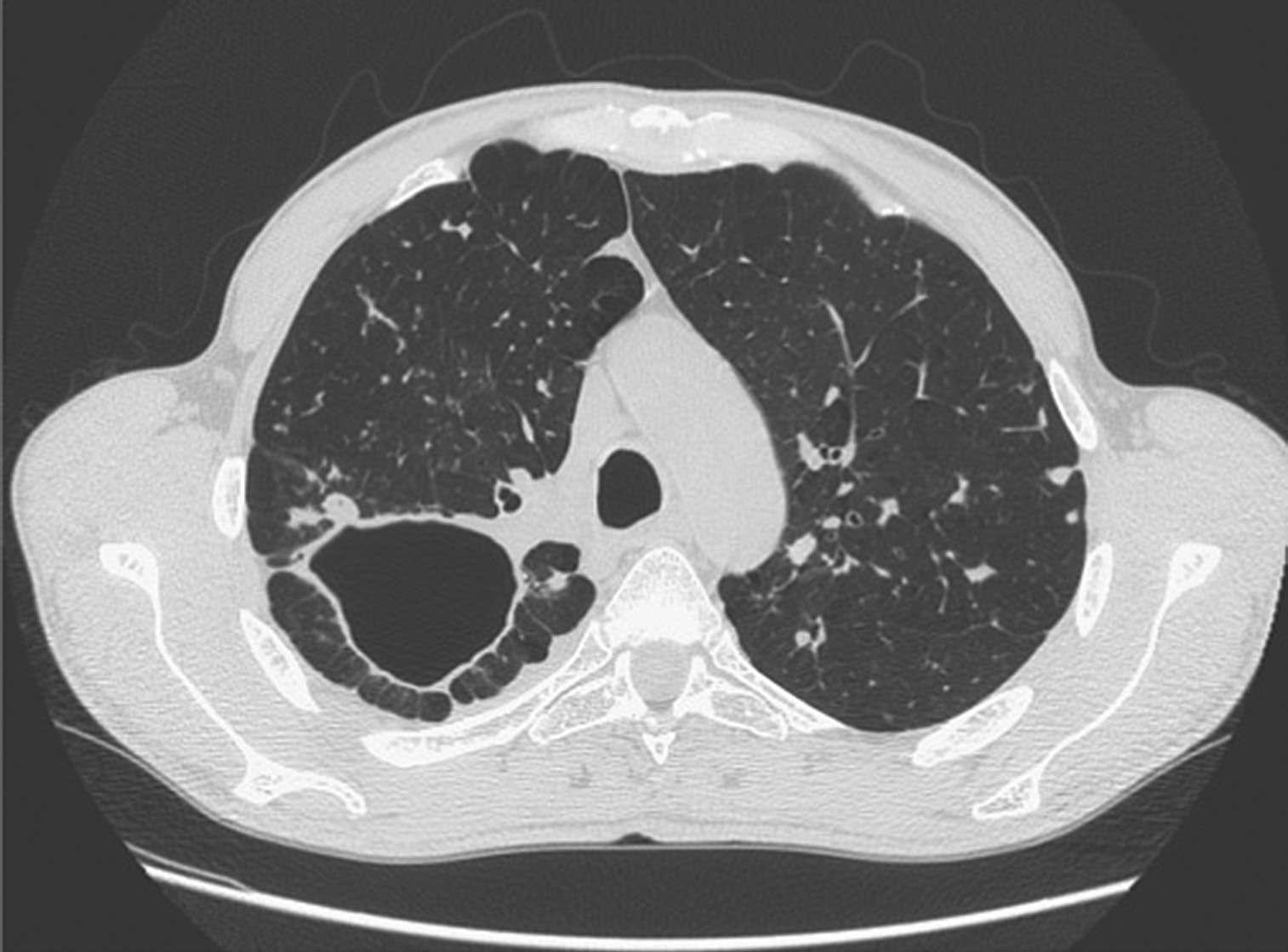 Chest radiograph showing right hilar lymph node enlargement with infiltration...