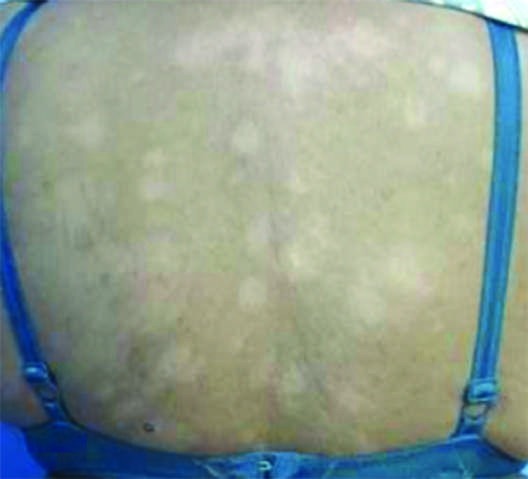 Tuberculoid (TT) leprosy