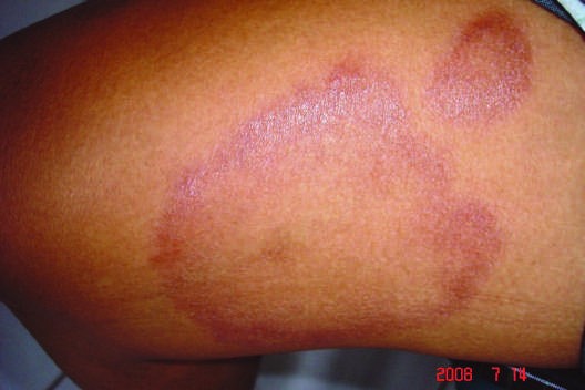 Tuberculoid (TT) leprosy