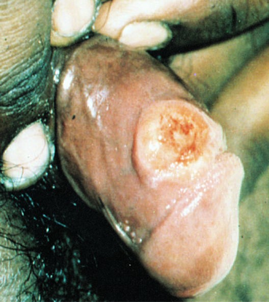 Primary syphilis with a firm, nontender chancre
