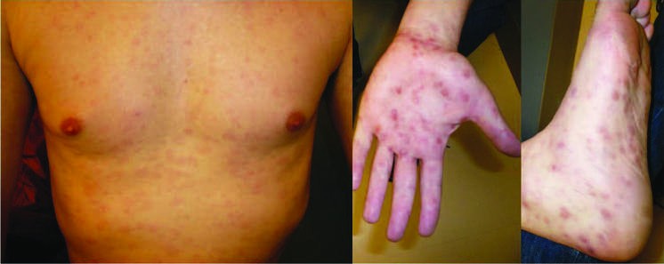Secondary syphilis