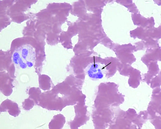 Peripheral-blood smear from a patient with human granulocytotropic anaplasmosis